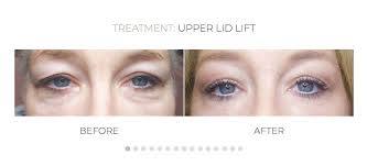 ACCOR Before After Image