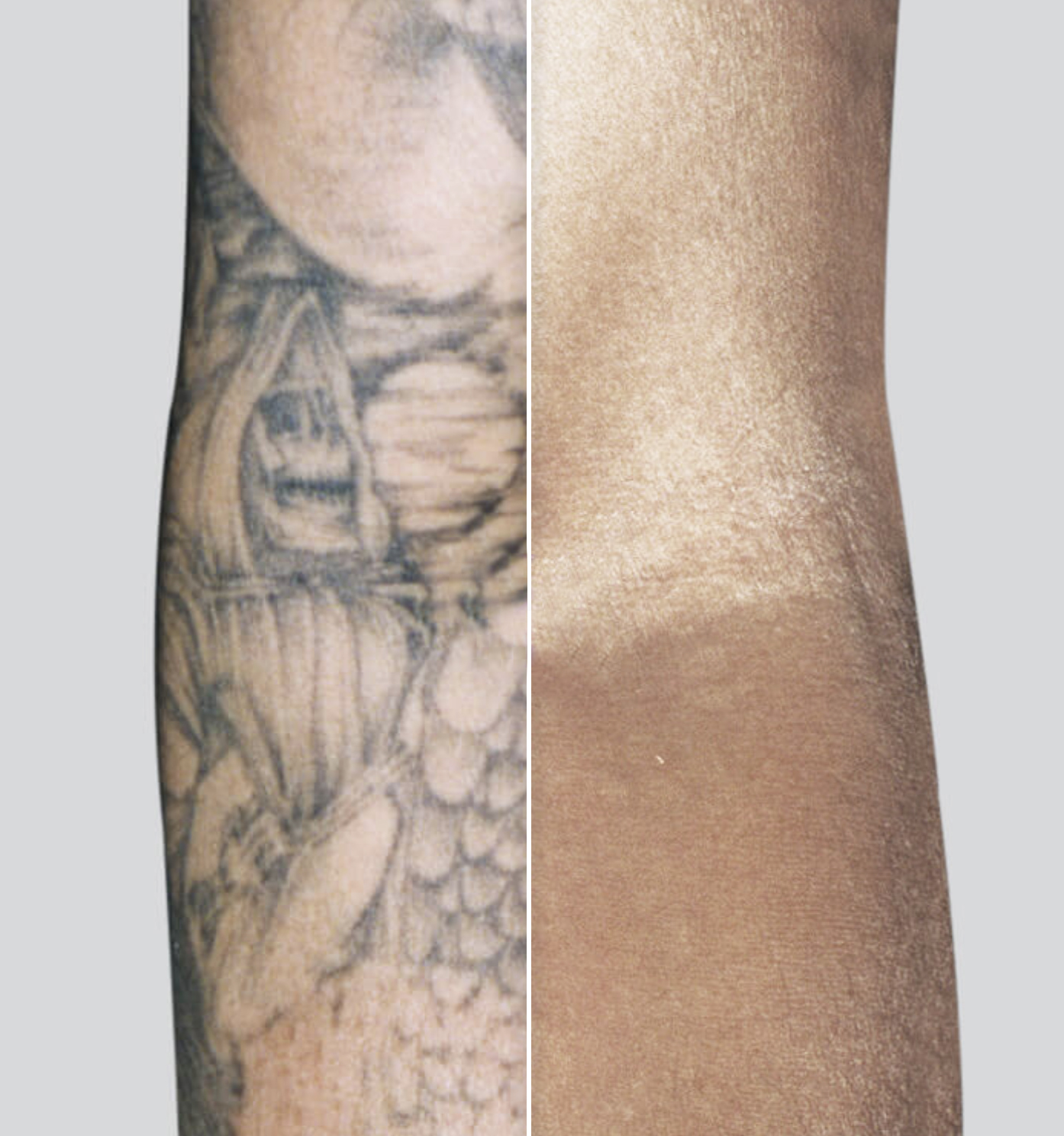 Laser Therapeutics | Laser Tattoo Removal
