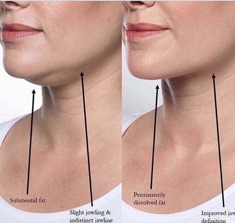 Laser Therapeutics Double Chin Treatment